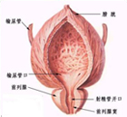 前列腺增生